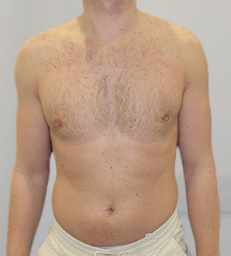 Auralia patient 1, after male chest reduction