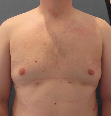 Auralia patient 7, after male chest reduction
