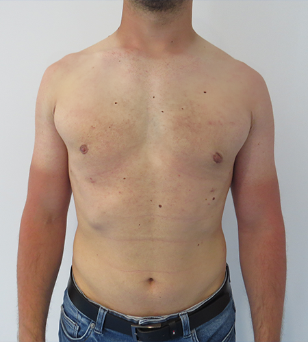 Auralia patient 2, after male chest reduction