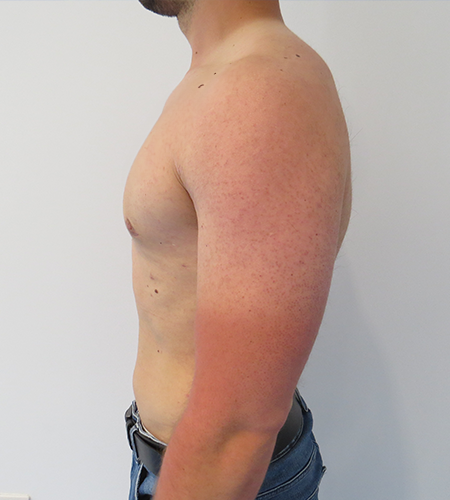 Auralia patient 6, after male chest reduction