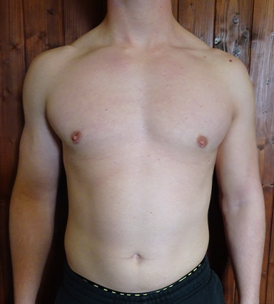 Auralia patient 4, after male chest reduction