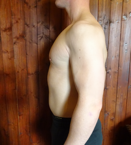 Auralia patient 3, after male chest reduction