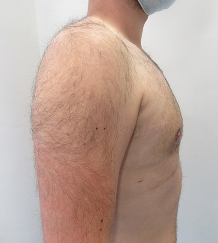 Auralia patient 5, after male chest reduction