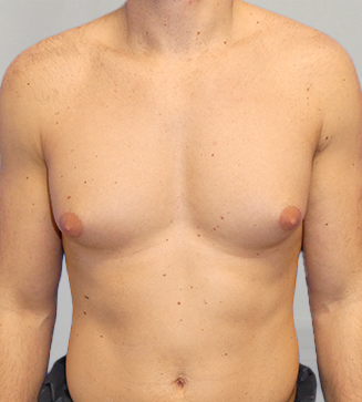 Auralia patient 1, before male chest reduction