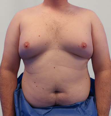 Auralia patient 7, before male chest reduction