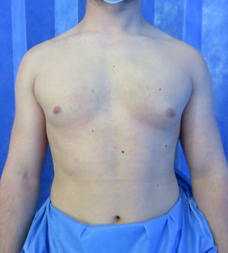 Auralia patient 2, before male chest reduction