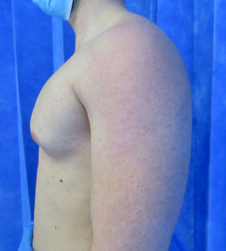 Auralia patient 6, before male chest reduction