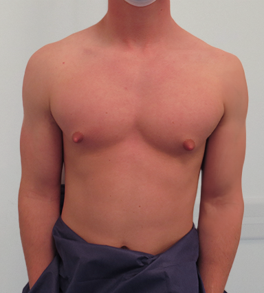 Auralia patient 4, before male chest reduction