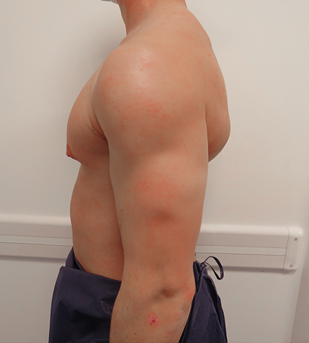 Auralia patient 3, before male chest reduction