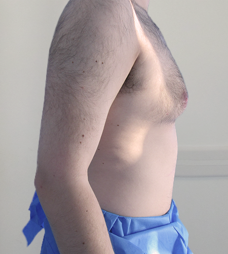 Auralia patient 5, before male chest reduction